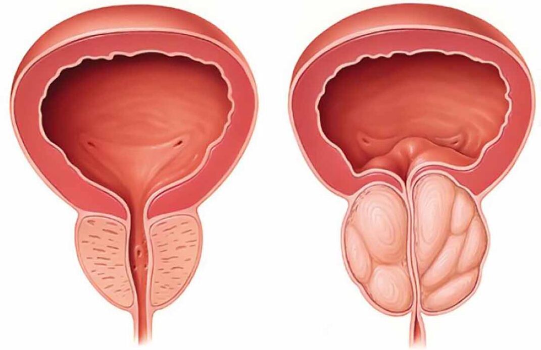 Normale Prostata und Entzündung der Prostata (chronische Prostatitis)