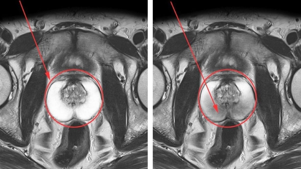 Ultraschall bei chronischer Prostatitis – gesunde Prostata (links) und entzündete (rechts)