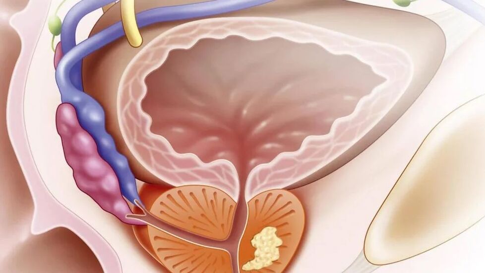 Nebakterielle chronische Prostatitis
